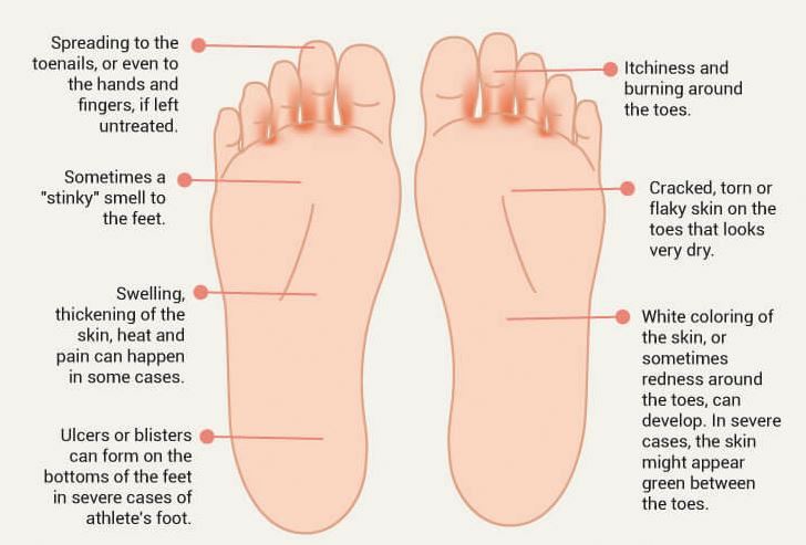 foot fungus cracked heels