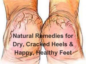 Paula Owens Natural Remedies for Athlete's Foot, Nail Fungus and Dry, Cracked Heels 2
